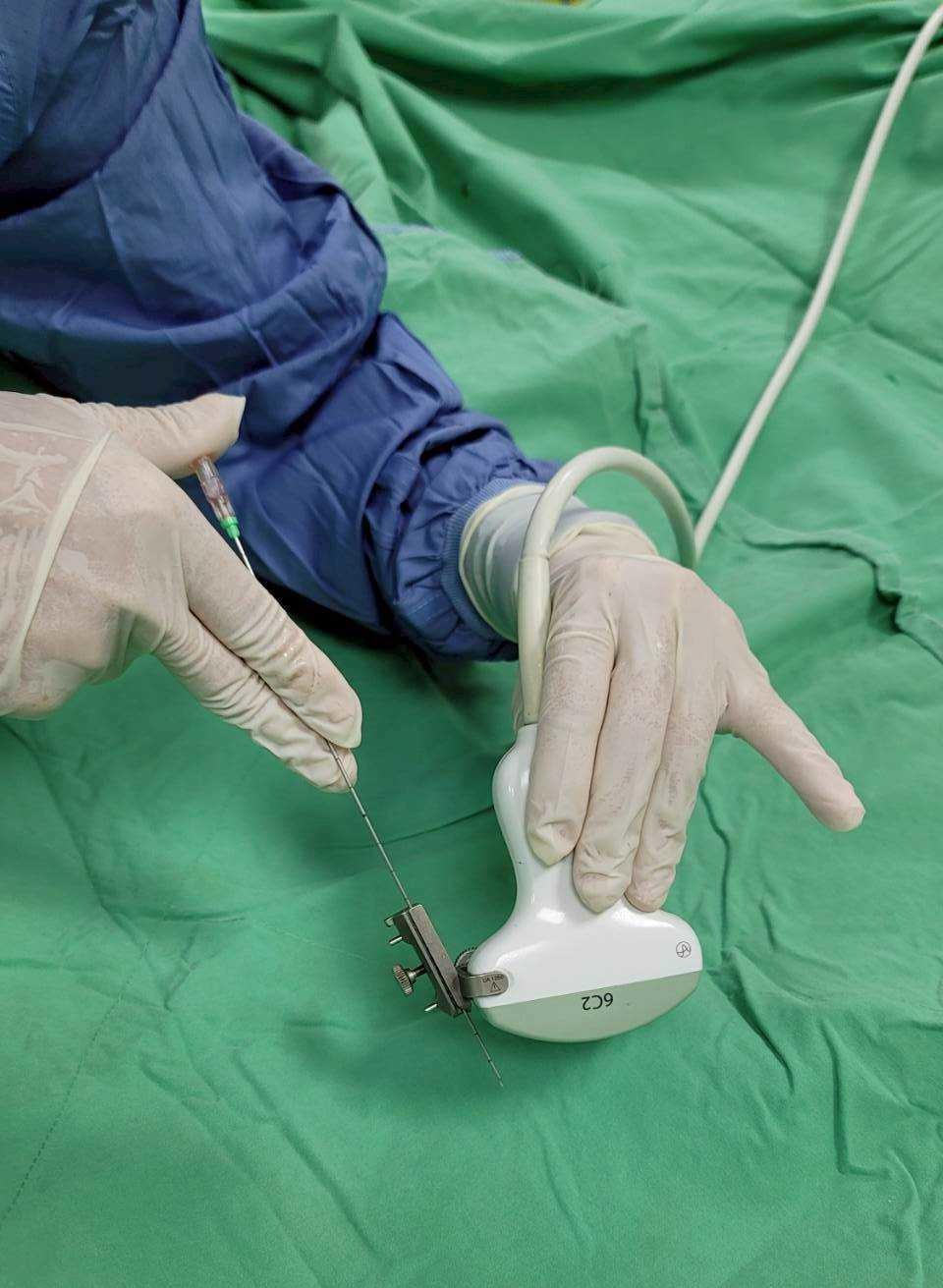 高齡長輩攝護腺肥大併發大出血　民生醫院泌尿科團隊緊急手術助轉危為安1